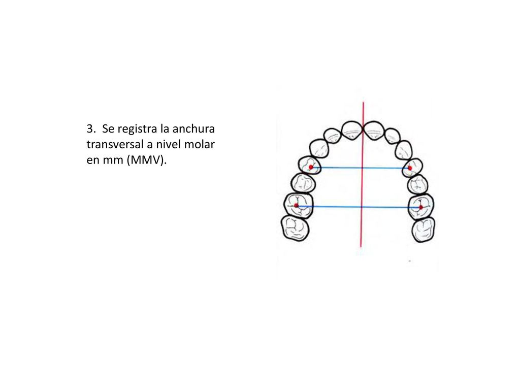 3. Se registra la anchura transversal a nivel molar en mm (MMV).