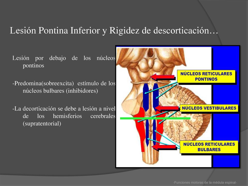 Lesión Pontina Inferior y Rigidez de descorticación…
