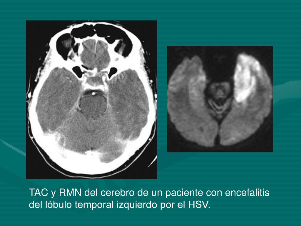 TAC y RMN del cerebro de un paciente con encefalitis del lóbulo temporal izquierdo por el HSV.