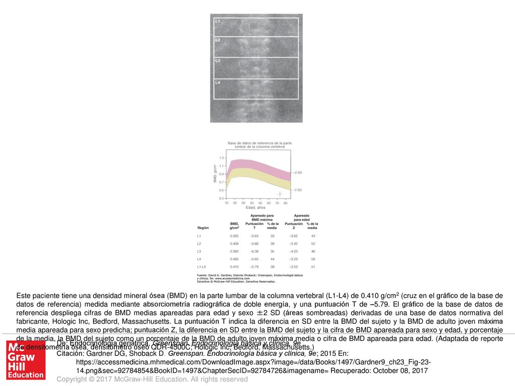 Este paciente tiene una densidad mineral ósea (BMD) en la parte lumbar de la columna vertebral (L1-L4) de g/cm2 (cruz en el gráfico de la base de datos de referencia) medida mediante absorciometría radiográfica de doble energía, y una puntuación T de –5.79. El gráfico de la base de datos de referencia despliega cifras de BMD medias apareadas para edad y sexo ±2 SD (áreas sombreadas) derivadas de una base de datos normativa del fabricante, Hologic Inc, Bedford, Massachusetts. La puntuación T indica la diferencia en SD entre la BMD del sujeto y la BMD de adulto joven máxima media apareada para sexo predicha; puntuación Z, la diferencia en SD entre la BMD del sujeto y la cifra de BMD apareada para sexo y edad, y porcentaje de la media, la BMD del sujeto como un porcentaje de la BMD de adulto joven máxima media o cifra de BMD apareada para edad. (Adaptada de reporte de densitometría ósea, densitómetro óseo QDR-4500C; Hologic Inc, Bedford, Massachusetts.)