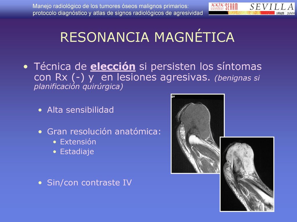 RESONANCIA MAGNÉTICA Técnica de elección si persisten los síntomas con Rx (-) y en lesiones agresivas. (benignas si planificación quirúrgica)