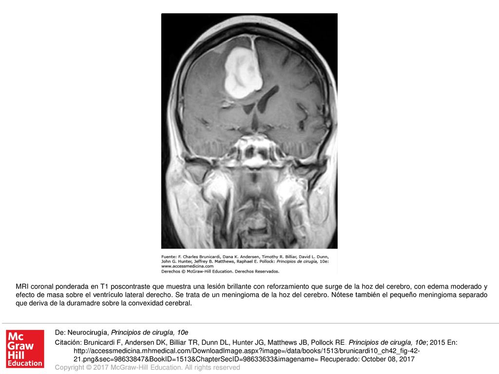 MRI coronal ponderada en T1 poscontraste que muestra una lesión brillante con reforzamiento que surge de la hoz del cerebro, con edema moderado y efecto de masa sobre el ventrículo lateral derecho. Se trata de un meningioma de la hoz del cerebro. Nótese también el pequeño meningioma separado que deriva de la duramadre sobre la convexidad cerebral.