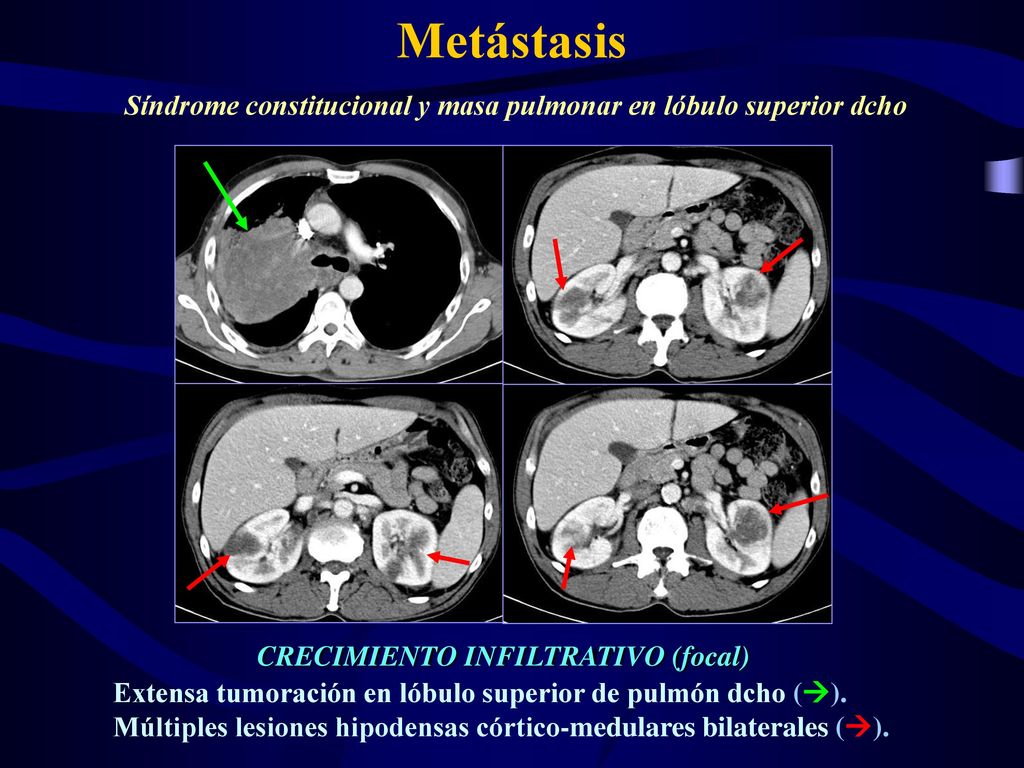 Metástasis Síndrome constitucional y masa pulmonar en lóbulo superior dcho. CRECIMIENTO INFILTRATIVO (focal)