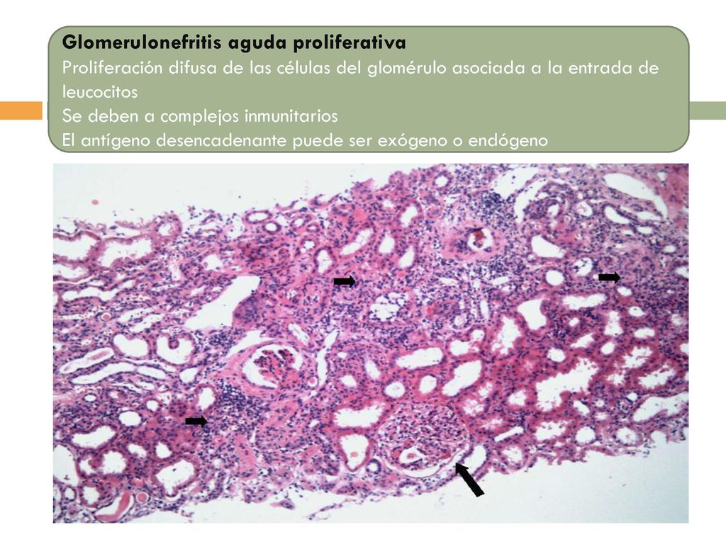 Glomerulonefritis aguda proliferativa Proliferación difusa de las células del glomérulo asociada a la entrada de leucocitos Se deben a complejos inmunitarios El antígeno desencadenante puede ser exógeno o endógeno