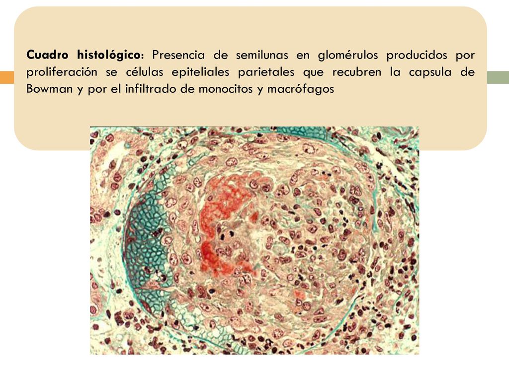 Cuadro histológico: Presencia de semilunas en glomérulos producidos por proliferación se células epiteliales parietales que recubren la capsula de Bowman y por el infiltrado de monocitos y macrófagos