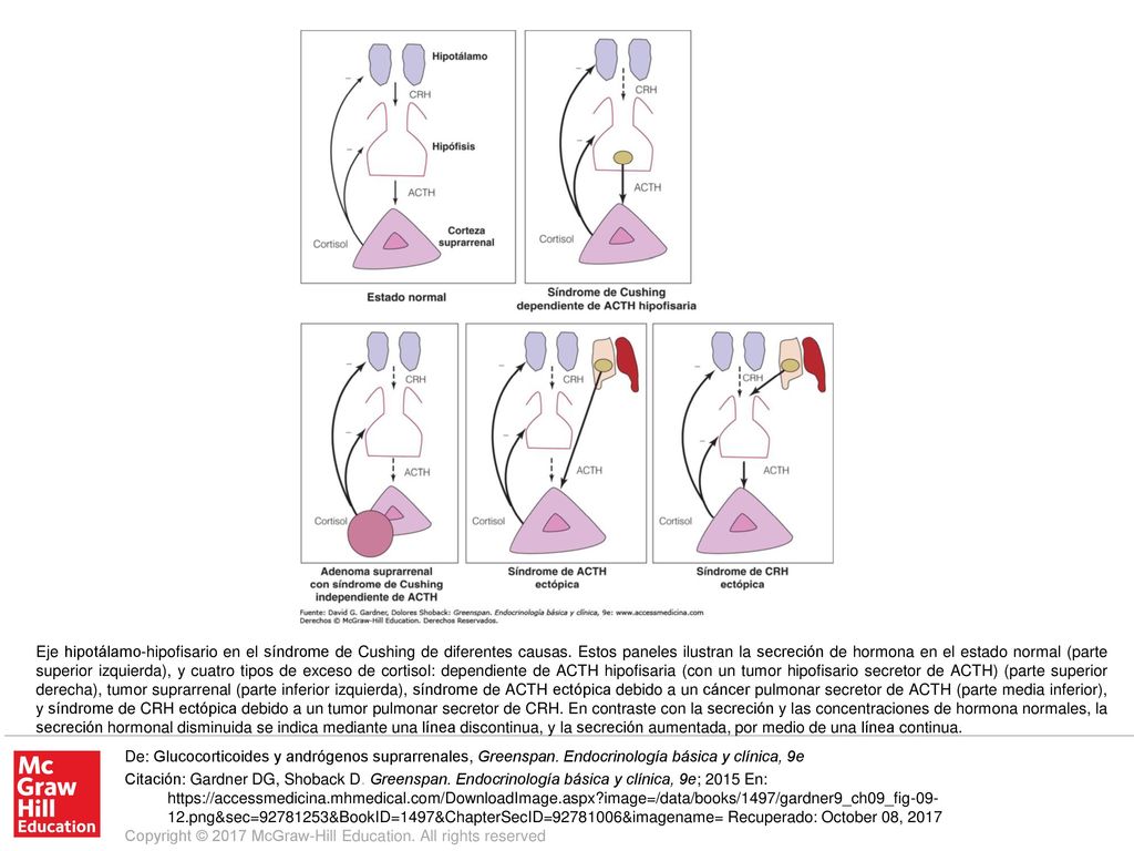 Eje hipotálamo-hipofisario en el síndrome de Cushing de diferentes causas. Estos paneles ilustran la secreción de hormona en el estado normal (parte superior izquierda), y cuatro tipos de exceso de cortisol: dependiente de ACTH hipofisaria (con un tumor hipofisario secretor de ACTH) (parte superior derecha), tumor suprarrenal (parte inferior izquierda), síndrome de ACTH ectópica debido a un cáncer pulmonar secretor de ACTH (parte media inferior), y síndrome de CRH ectópica debido a un tumor pulmonar secretor de CRH. En contraste con la secreción y las concentraciones de hormona normales, la secreción hormonal disminuida se indica mediante una línea discontinua, y la secreción aumentada, por medio de una línea continua.
