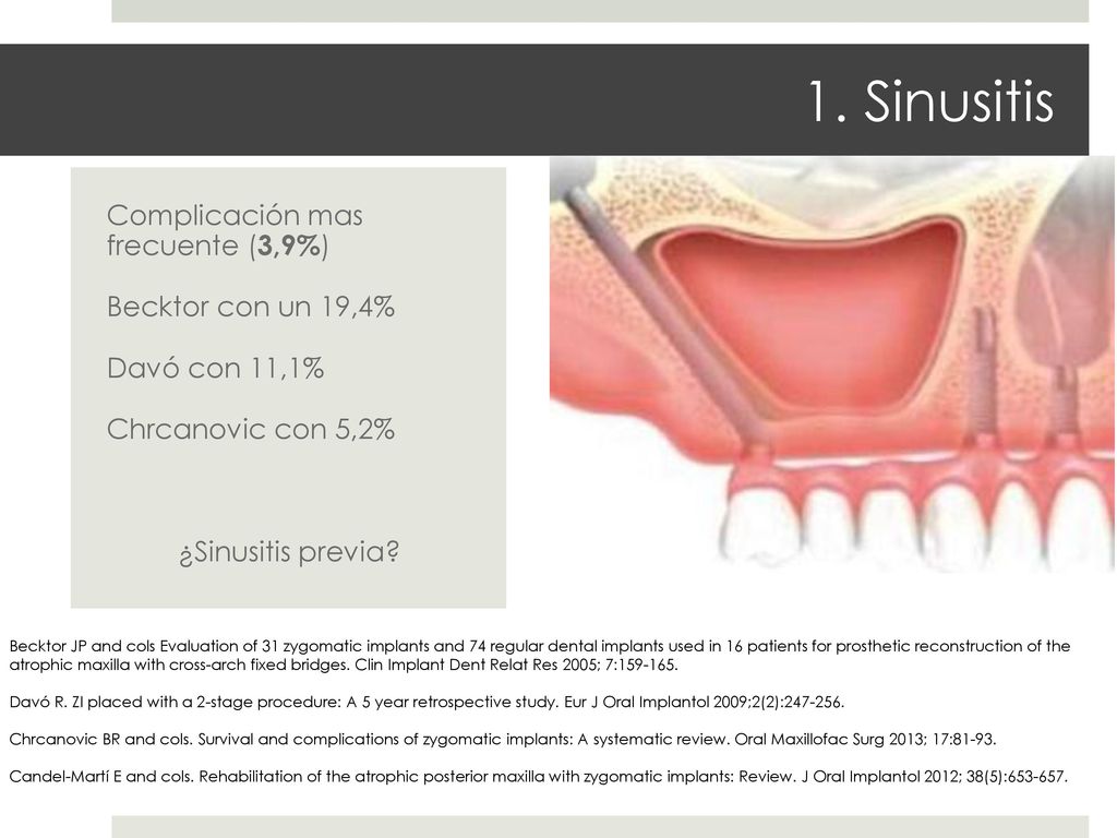 1. Sinusitis Complicación mas frecuente (3,9%) Becktor con un 19,4%