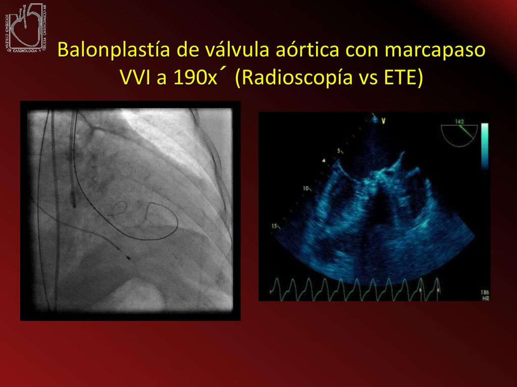 Balonplastía de válvula aórtica con marcapaso VVI a 190x´ (Radioscopía vs ETE)