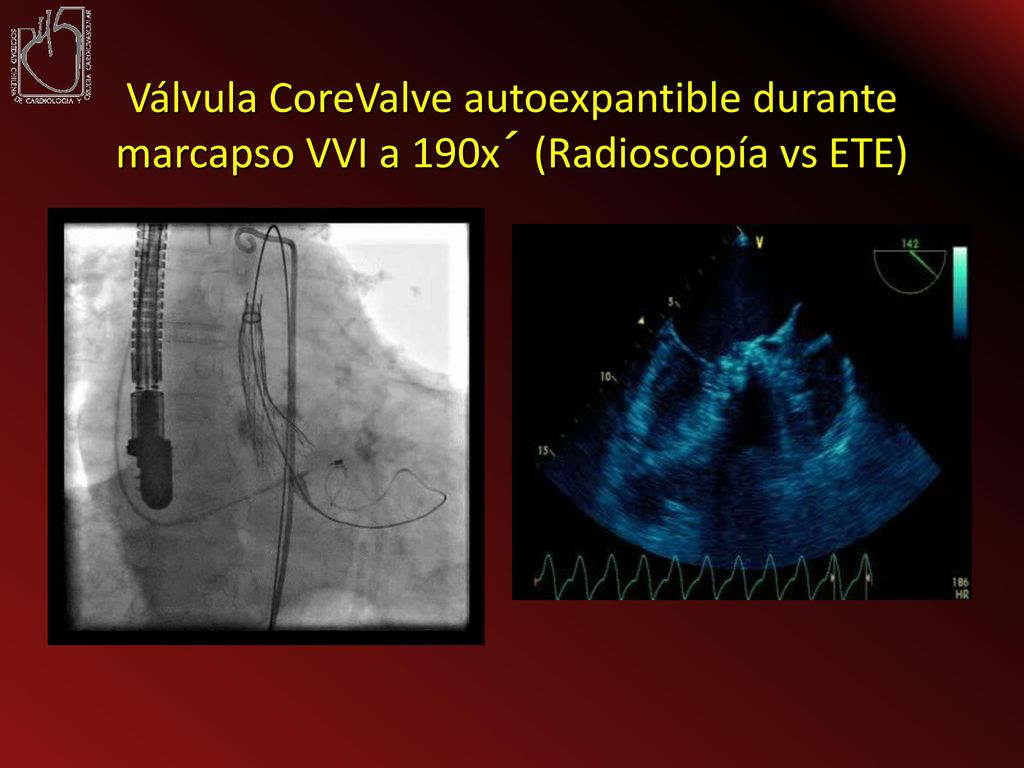 Válvula CoreValve autoexpantible durante marcapso VVI a 190x´ (Radioscopía vs ETE)