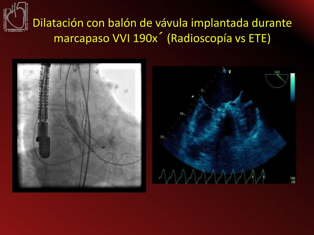 Dilatación con balón de vávula implantada durante marcapaso VVI 190x´ (Radioscopía vs ETE)