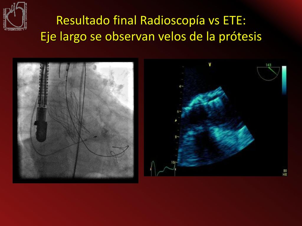 Resultado final Radioscopía vs ETE: Eje largo se observan velos de la prótesis
