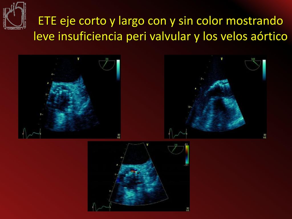 ETE eje corto y largo con y sin color mostrando leve insuficiencia peri valvular y los velos aórtico