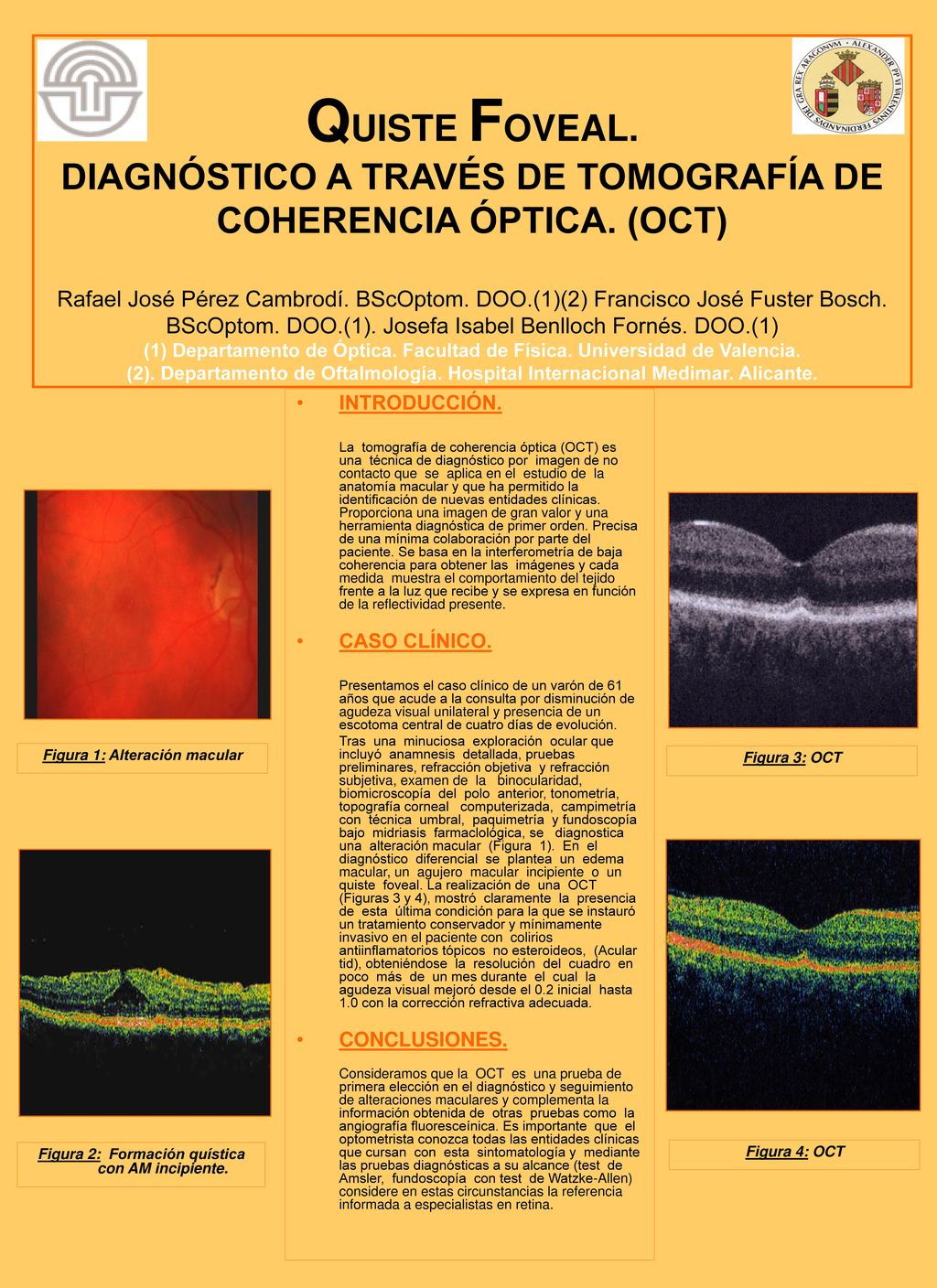 QUISTE FOVEAL. DIAGNÓSTICO A TRAVÉS DE TOMOGRAFÍA DE COHERENCIA ÓPTICA