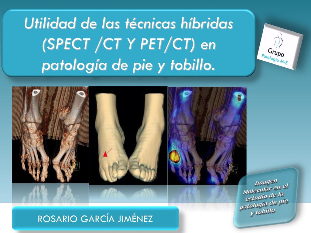 Imagen Molecular en el estudio de la patología de pie y tobillo