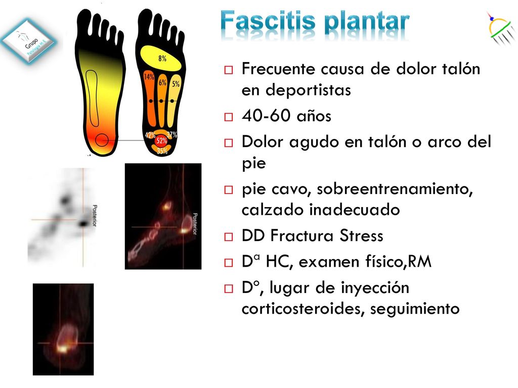 Fascitis plantar Frecuente causa de dolor talón en deportistas
