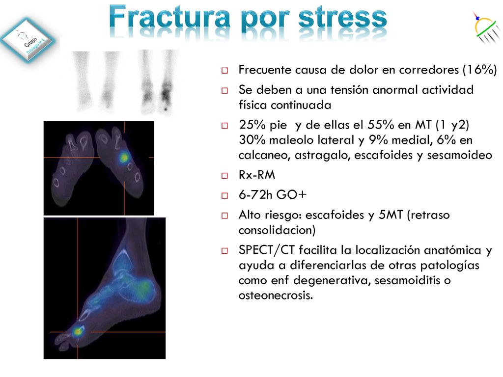Fractura por stress Frecuente causa de dolor en corredores (16%)