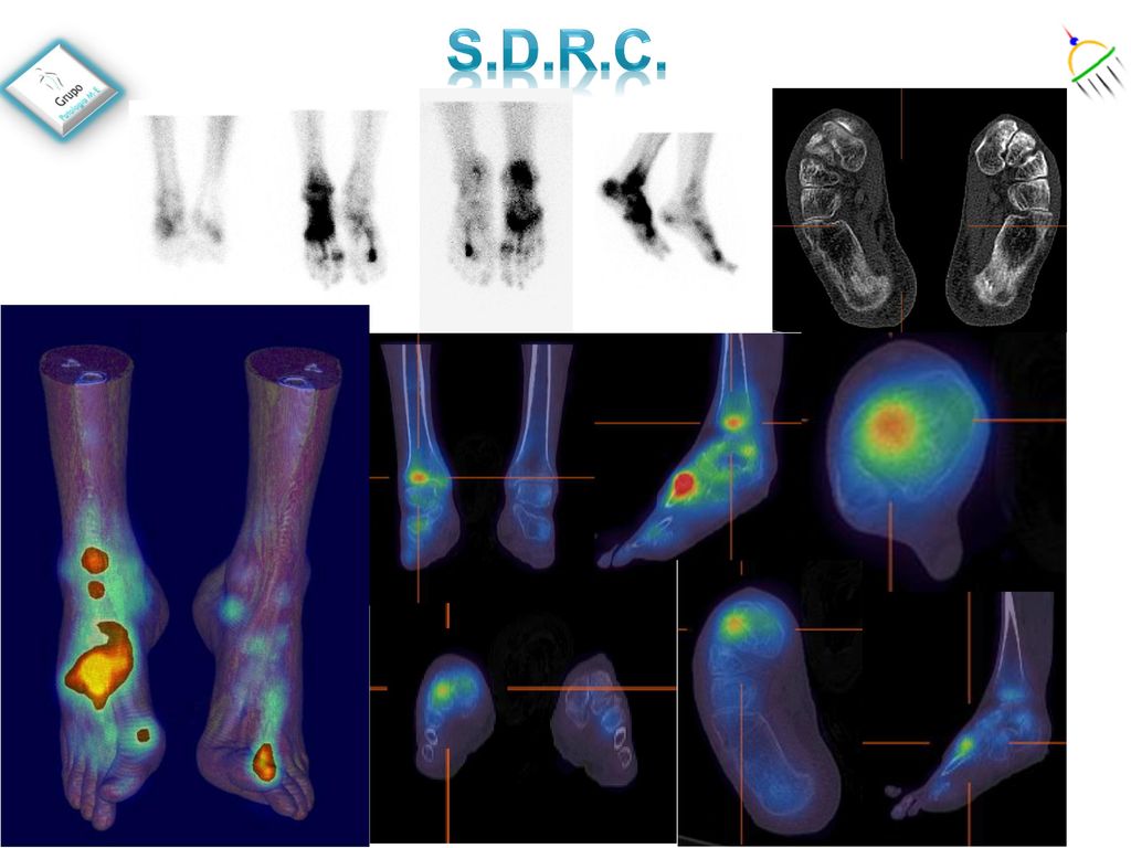 S.D.R.C. Varon 52 años Paciente que comenzó con dolor tarsometatarsal derecho hace unos seis.