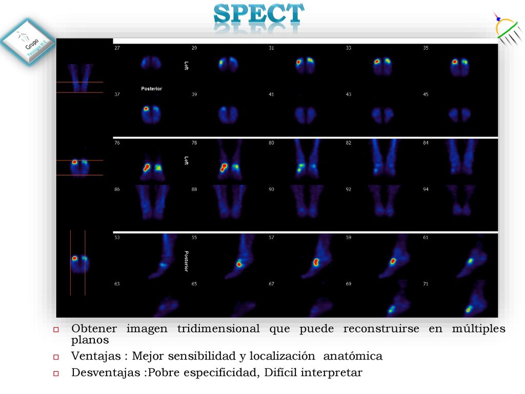 SPECT Obtener imagen tridimensional que puede reconstruirse en múltiples planos. Ventajas : Mejor sensibilidad y localización anatómica.