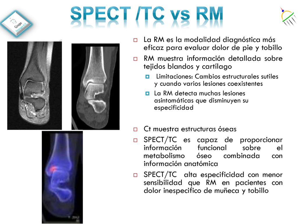 SPECT /TC vs RM La RM es la modalidad diagnóstica más eficaz para evaluar dolor de pie y tobillo.