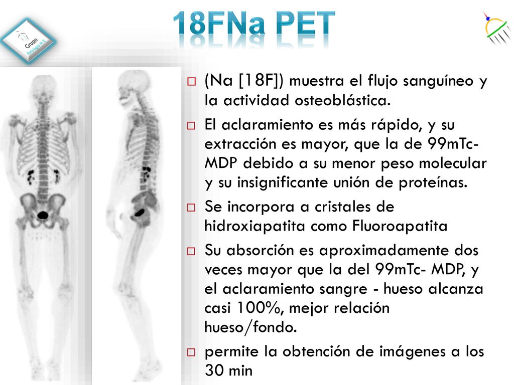 18FNa PET (Na [18F]) muestra el flujo sanguíneo y la actividad osteoblástica.
