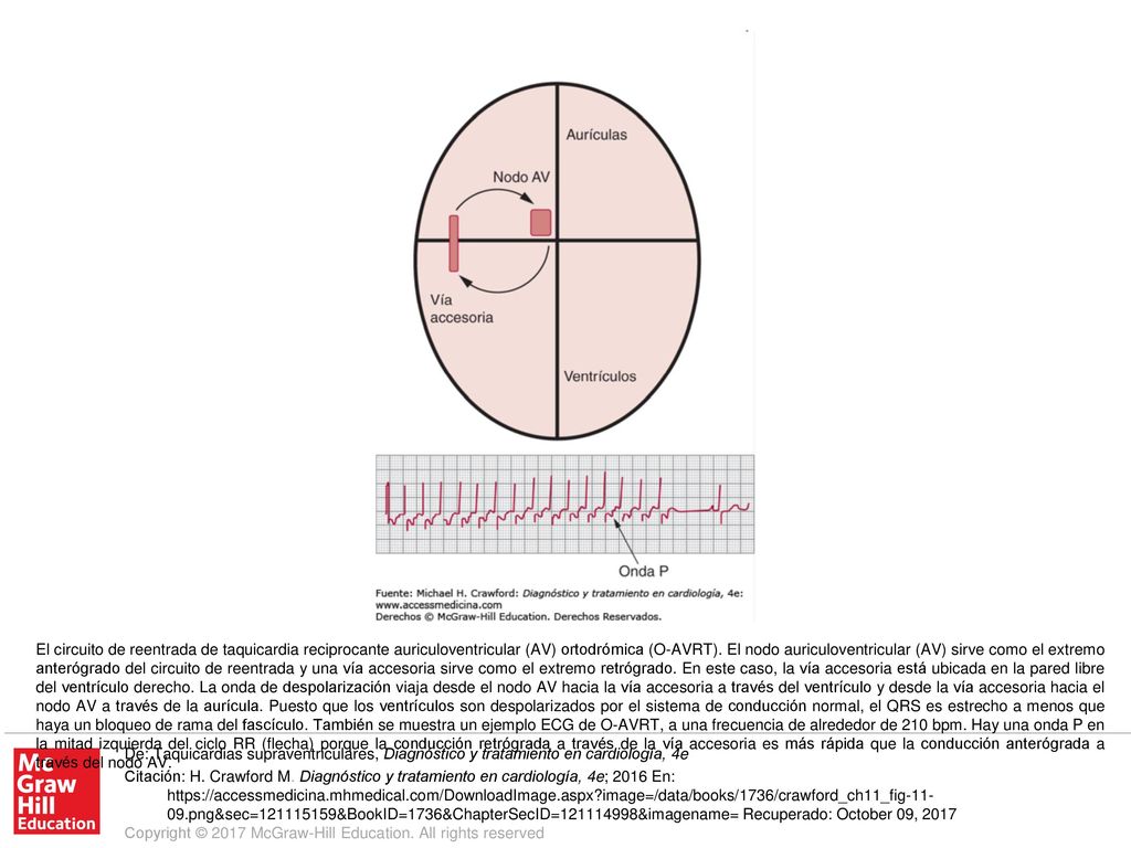 El circuito de reentrada de taquicardia reciprocante auriculoventricular (AV) ortodrómica (O-AVRT). El nodo auriculoventricular (AV) sirve como el extremo anterógrado del circuito de reentrada y una vía accesoria sirve como el extremo retrógrado. En este caso, la vía accesoria está ubicada en la pared libre del ventrículo derecho. La onda de despolarización viaja desde el nodo AV hacia la vía accesoria a través del ventrículo y desde la vía accesoria hacia el nodo AV a través de la aurícula. Puesto que los ventrículos son despolarizados por el sistema de conducción normal, el QRS es estrecho a menos que haya un bloqueo de rama del fascículo. También se muestra un ejemplo ECG de O-AVRT, a una frecuencia de alrededor de 210 bpm. Hay una onda P en la mitad izquierda del ciclo RR (flecha) porque la conducción retrógrada a través de la vía accesoria es más rápida que la conducción anterógrada a través del nodo AV.