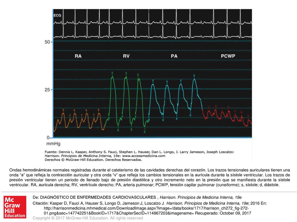 Ondas hemodinámicas normales registradas durante el cateterismo de las cavidades derechas del corazón. Los trazos tensionales auriculares tienen una onda a que refleja la contracción auricular y otra onda v que refleja los cambios tensionales en la aurícula durante la sístole ventricular. Los trazos de presión ventricular tienen un periodo de llenado bajo de presión diastólica y otro incremento neto en la presión que se manifiesta durante la sístole ventricular. RA, aurícula derecha; RV, ventrículo derecho; PA, arteria pulmonar; PCWP, tensión capilar pulmonar (cuneiforme); s, sístole; d, diástole.