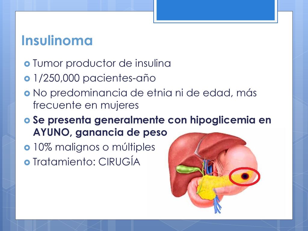 Insulinoma Tumor productor de insulina 1/250,000 pacientes-año
