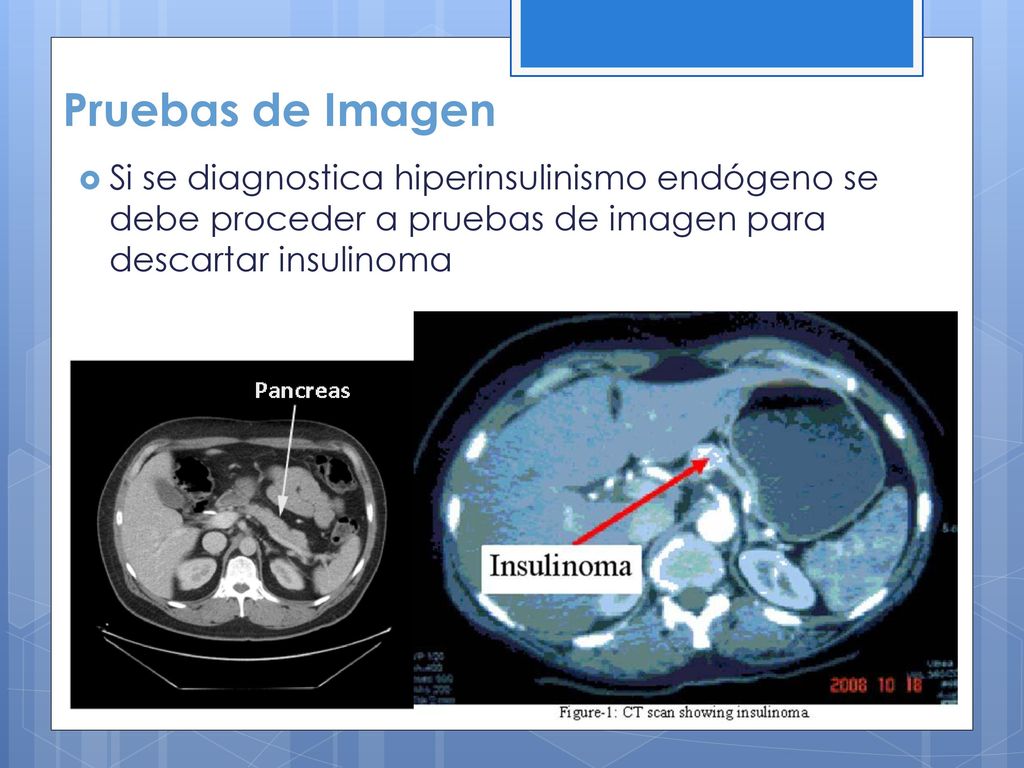 Pruebas de Imagen Si se diagnostica hiperinsulinismo endógeno se debe proceder a pruebas de imagen para descartar insulinoma.