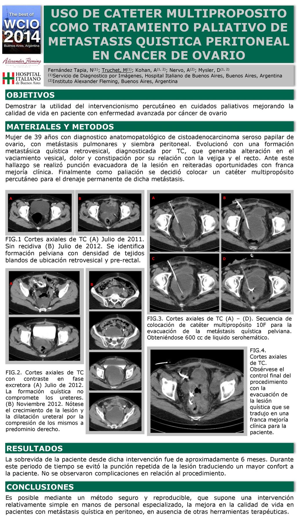 USO DE CATETER MULTIPROPOSITO COMO TRATAMIENTO PALIATIVO DE METASTASIS QUISTICA PERITONEAL EN CANCER DE OVARIO