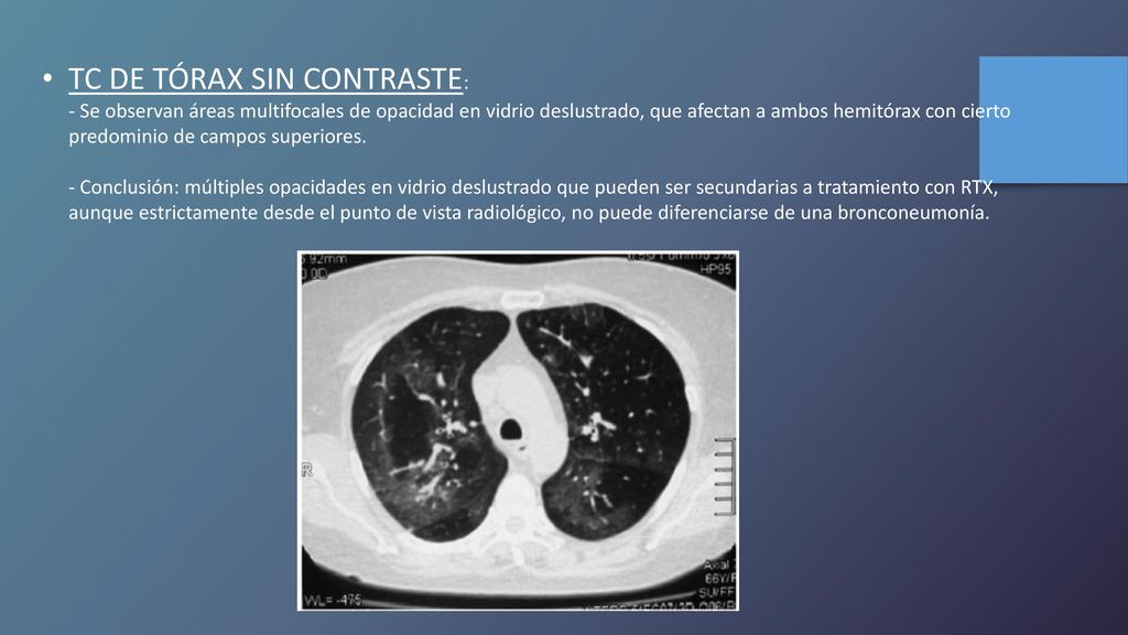 TC DE TÓRAX SIN CONTRASTE: - Se observan áreas multifocales de opacidad en vidrio deslustrado, que afectan a ambos hemitórax con cierto predominio de campos superiores.