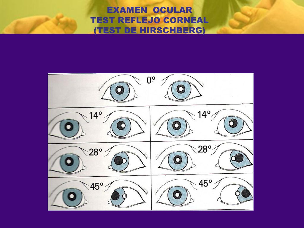 EXAMEN OCULAR TEST REFLEJO CORNEAL (TEST DE HIRSCHBERG)