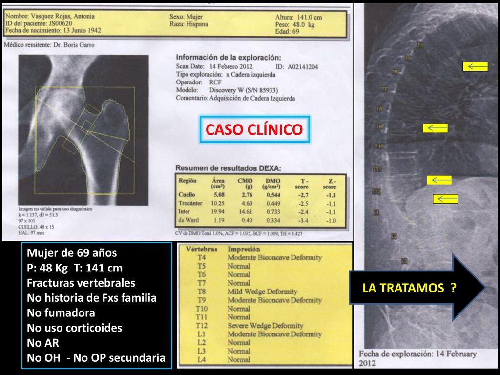 CASO CLÍNICO LA TRATAMOS Mujer de 69 años P: 48 Kg T: 141 cm