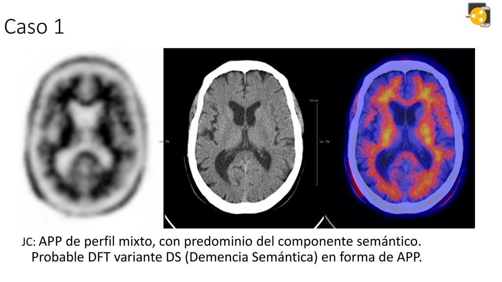 Caso 1 JC: APP de perfil mixto, con predominio del componente semántico.