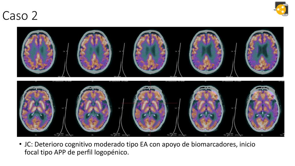 Caso 2 JC: Deterioro cognitivo moderado tipo EA con apoyo de biomarcadores, inicio focal tipo APP de perfil logopénico.