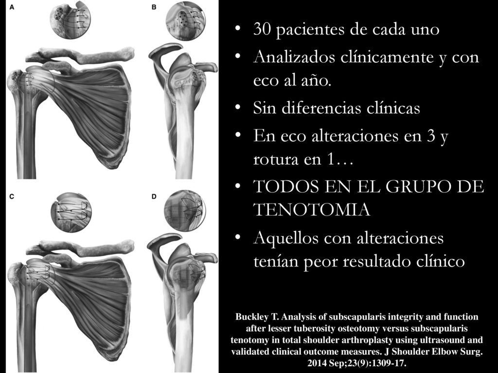 Analizados clínicamente y con eco al año. Sin diferencias clínicas