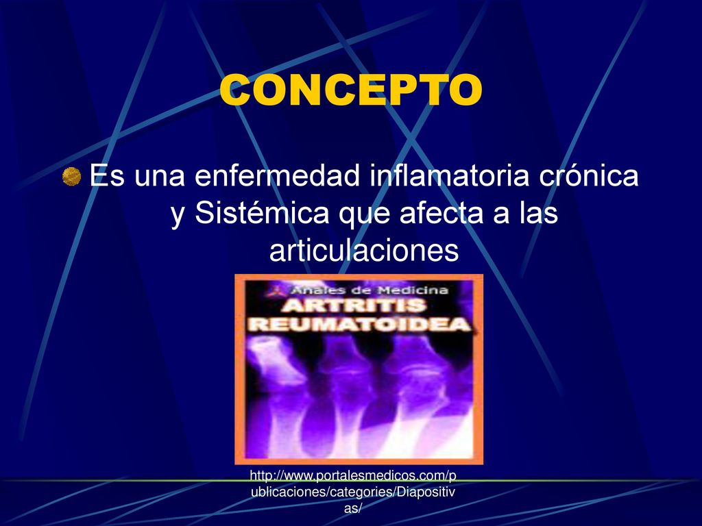 CONCEPTO Es una enfermedad inflamatoria crónica y Sistémica que afecta a las articulaciones.