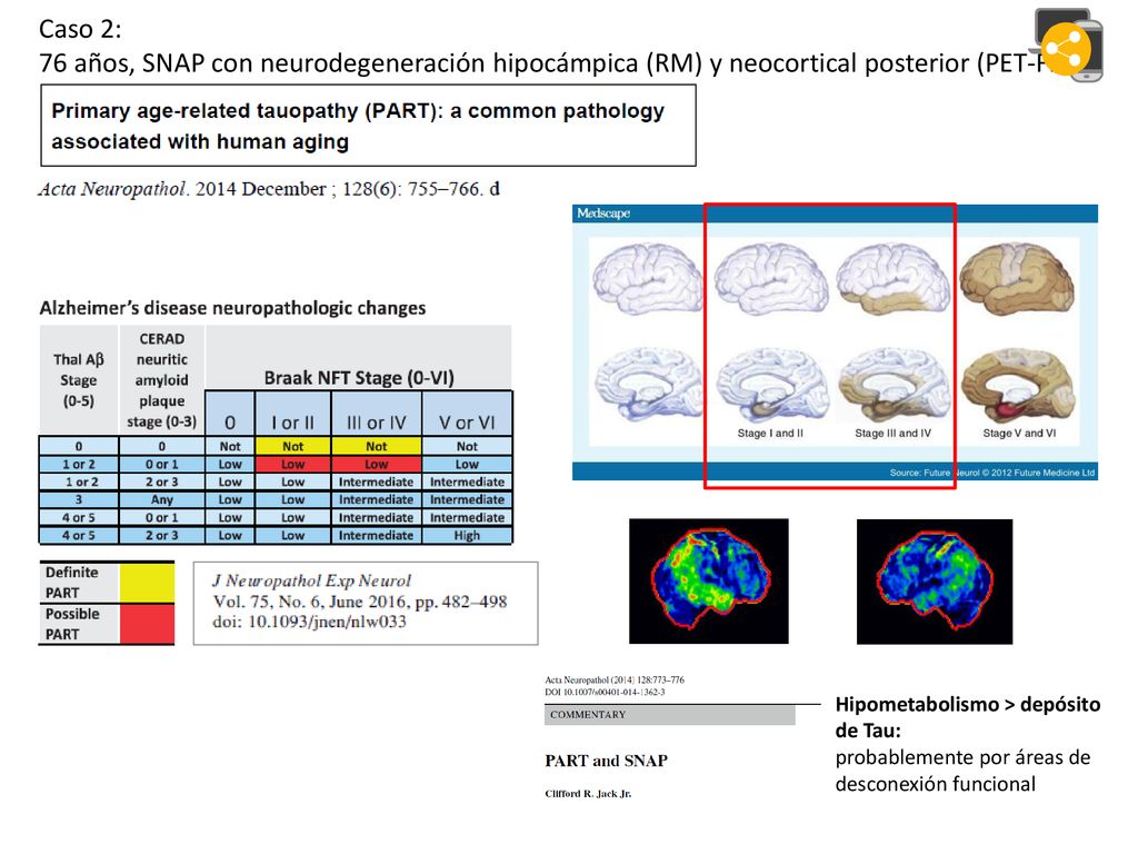 Caso 2: 76 años, SNAP con neurodegeneración hipocámpica (RM) y neocortical posterior (PET-FDG)