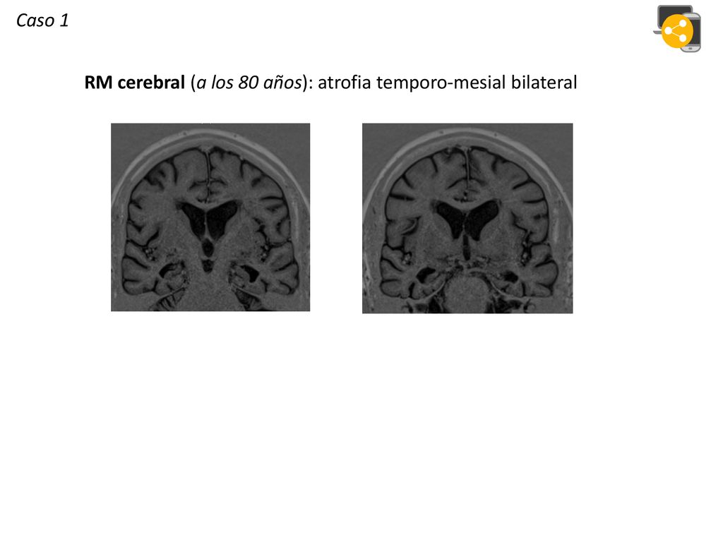 Caso 1 RM cerebral (a los 80 años): atrofia temporo-mesial bilateral