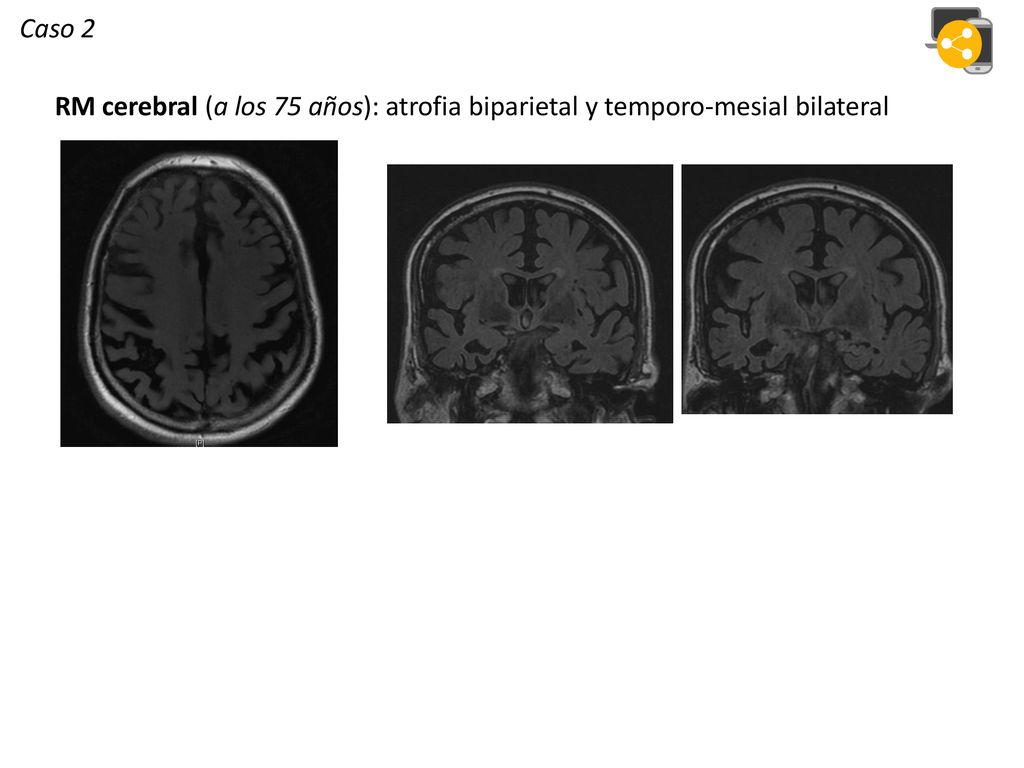 Caso 2 RM cerebral (a los 75 años): atrofia biparietal y temporo-mesial bilateral