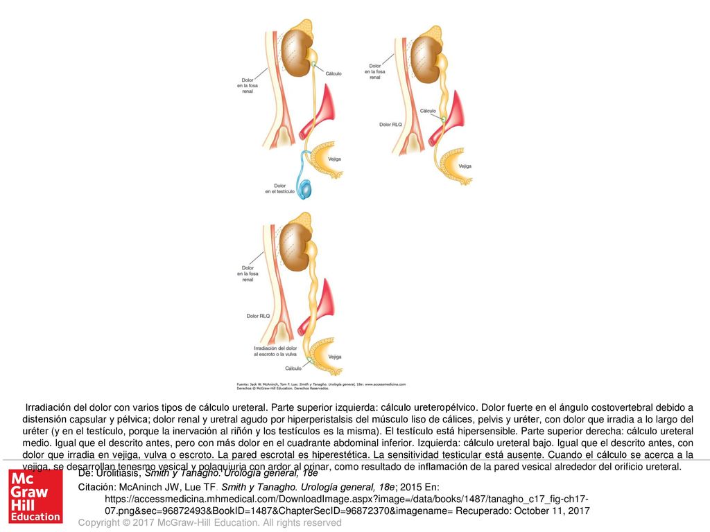 Irradiación del dolor con varios tipos de cálculo ureteral