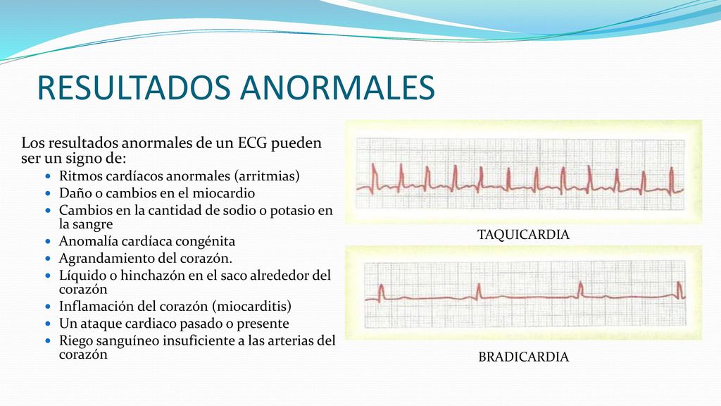 RESULTADOS ANORMALES Los resultados anormales de un ECG pueden ser un signo de: Ritmos cardíacos anormales (arritmias)