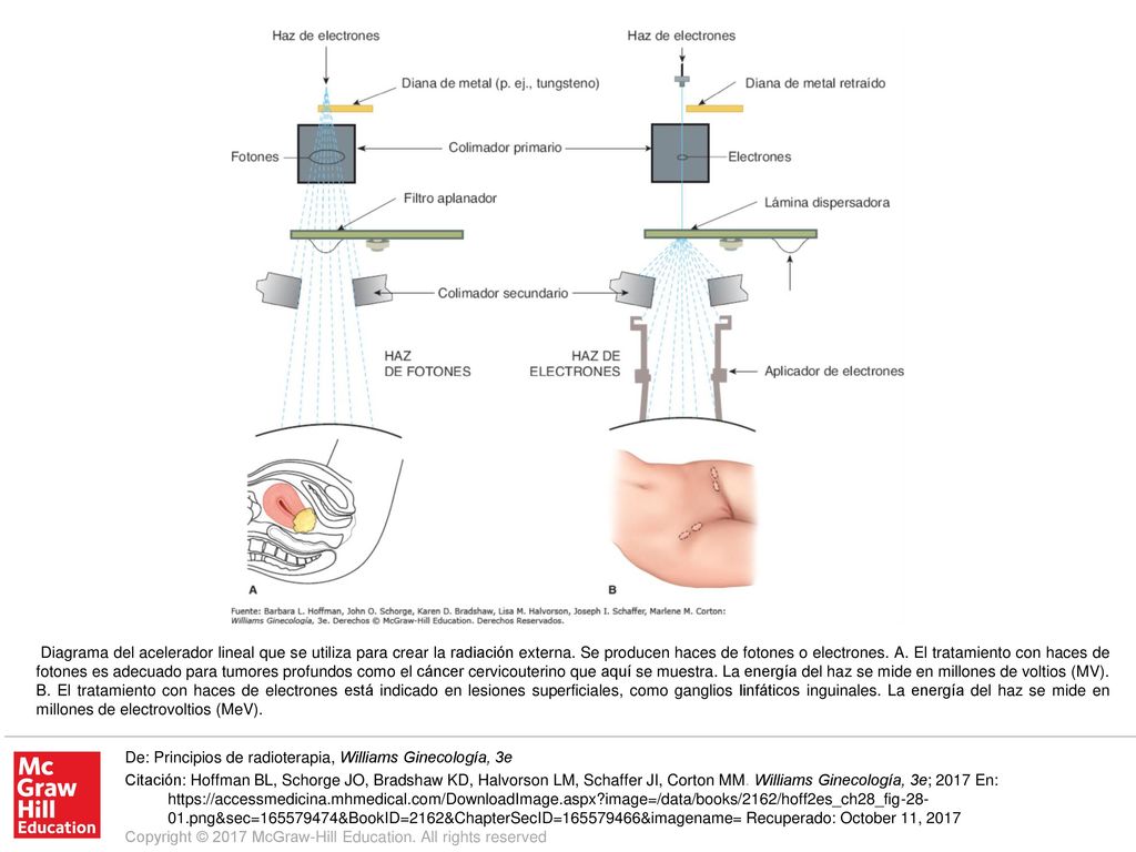 Diagrama del acelerador lineal que se utiliza para crear la radiación externa. Se producen haces de fotones o electrones. A. El tratamiento con haces de fotones es adecuado para tumores profundos como el cáncer cervicouterino que aquí se muestra. La energía del haz se mide en millones de voltios (MV). B. El tratamiento con haces de electrones está indicado en lesiones superficiales, como ganglios linfáticos inguinales. La energía del haz se mide en millones de electrovoltios (MeV).