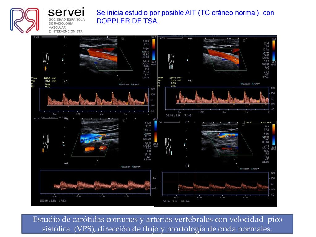 Se inicia estudio por posible AIT (TC cráneo normal), con DOPPLER DE TSA.