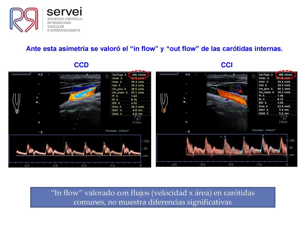 Ante esta asimetría se valoró el in flow y out flow de las carótidas internas.