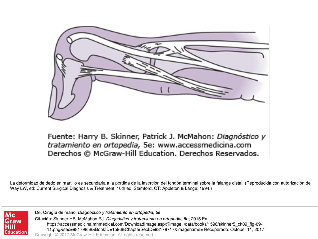 La deformidad de dedo en martillo es secundaria a la pérdida de la inserción del tendón terminal sobre la falange distal. (Reproducida con autorización de Way LW, ed: Current Surgical Diagnosis & Treatment, 10th ed. Stamford, CT: Appleton & Lange; 1994.)