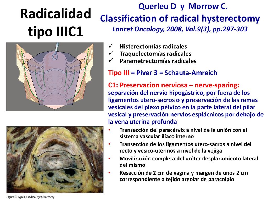 Radicalidad tipo IIIC1 Querleu D y Morrow C.