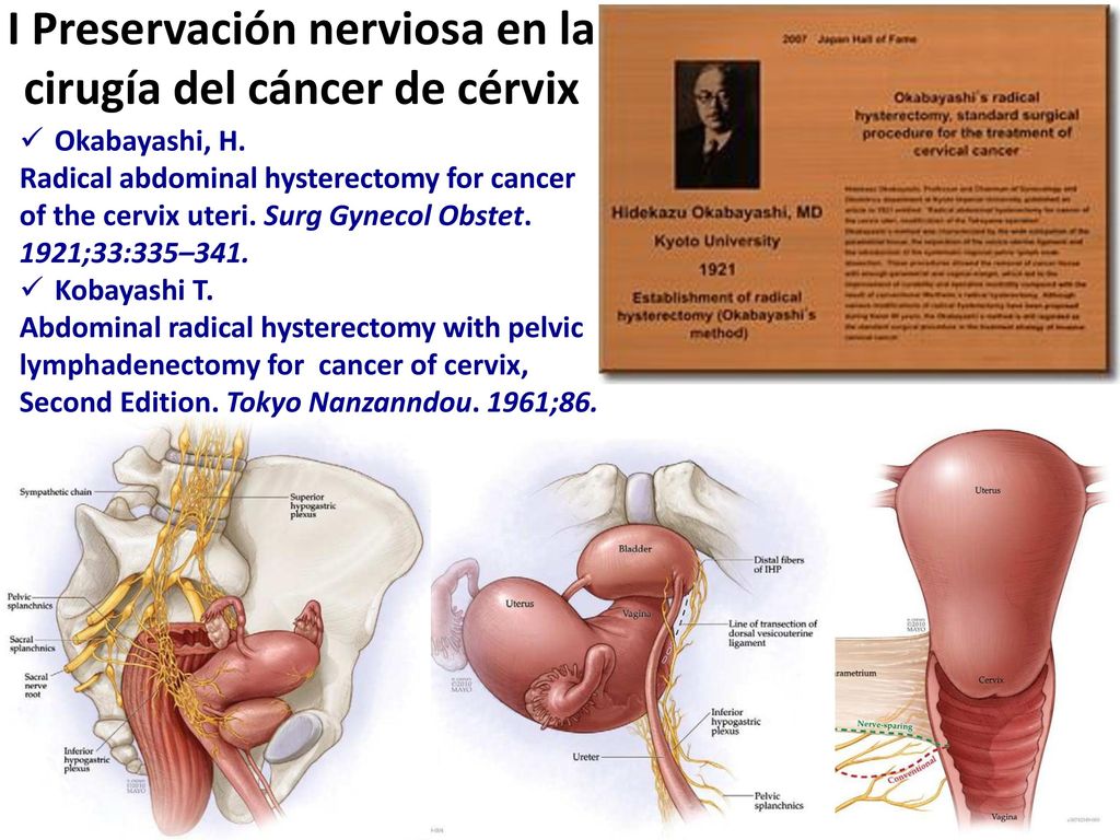 I Preservación nerviosa en la cirugía del cáncer de cérvix