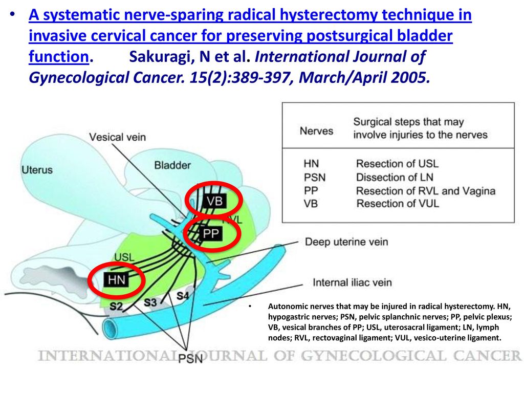 A systematic nerve‐sparing radical hysterectomy technique in invasive cervical cancer for preserving postsurgical bladder function. Sakuragi, N et al. International Journal of Gynecological Cancer. 15(2): , March/April 2005.