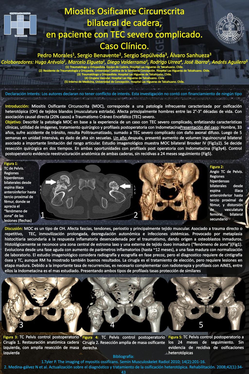 Miositis Osificante Circunscrita bilateral de cadera, en paciente con TEC severo complicado. Caso Clínico.