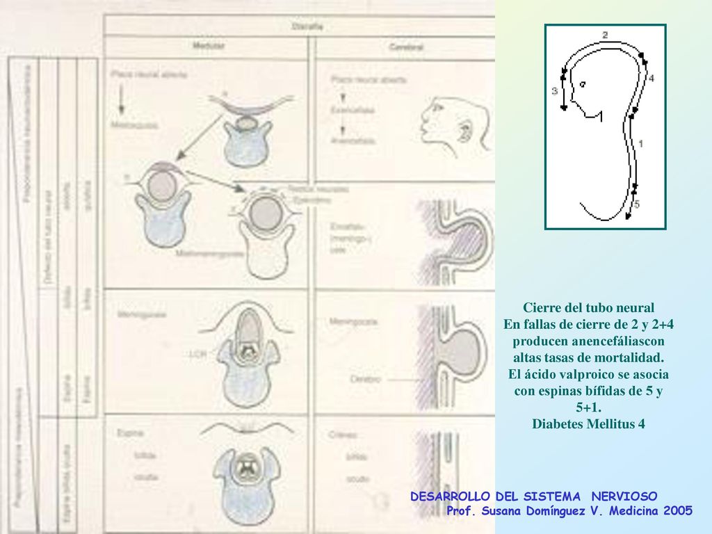 El ácido valproico se asocia con espinas bífidas de 5 y 5+1.